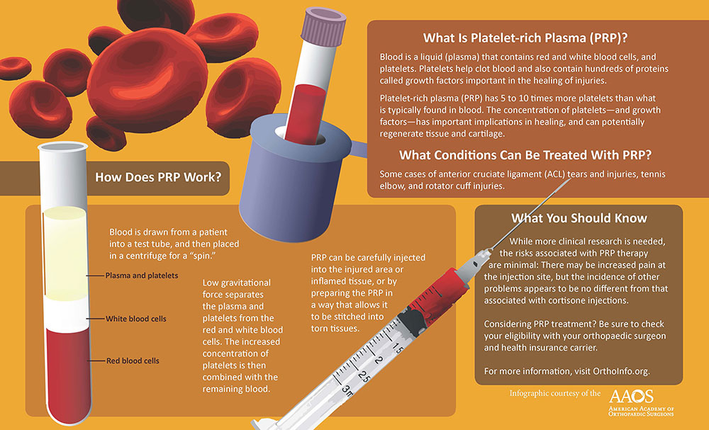 Platelet Rich Plasma Injection Protocol FYNSR Platelet Rich Plasma Injection Protocol FYNSR